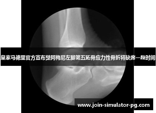 皇家马德里官方宣布楚阿梅尼左脚第五跖骨应力性骨折将缺席一段时间